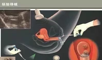 正规拉拉供卵代孕咨询试管婴儿中心
